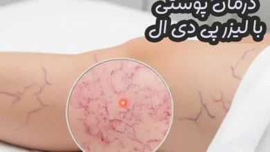 لیزر پی دی ال