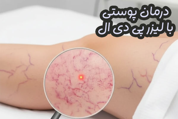 لیزر پی دی ال