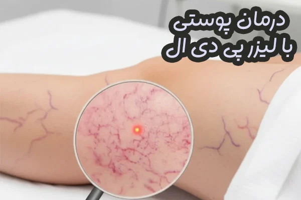 لیزر پی دی ال