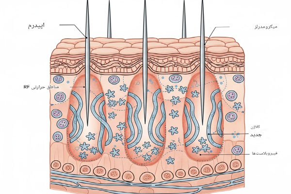 الا دستگاه لیزر آر اف فرکشنال