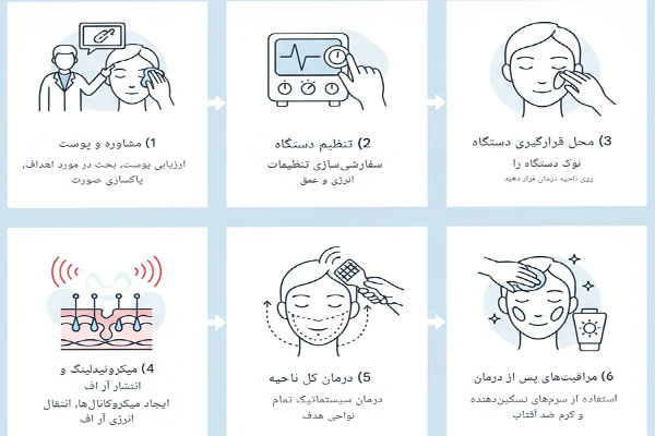 س نحوه کار دستگاه لیزر آر اف فرکشنال