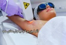 تاثیر لیزر بر فولیکول مو
