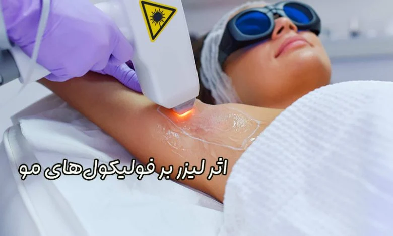 تاثیر لیزر بر فولیکول مو